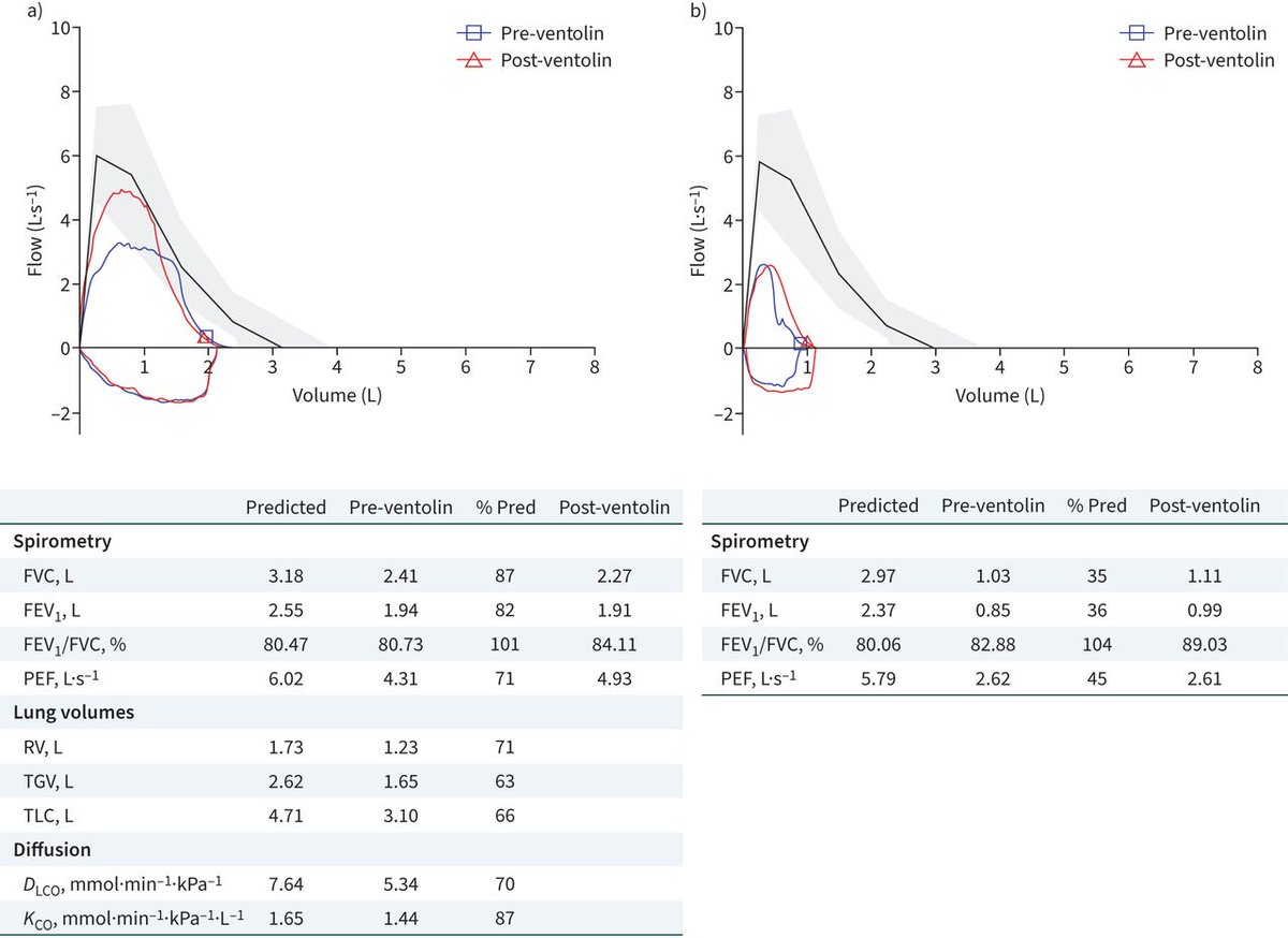 ERSpublications's tweet photo. Myasthenia gravis may affect respiratory muscles. To differentiate between other neuromuscular diseases, evaluation for muscle fatigability can be demonstrated by cardiopulmonary exercise testing and the maximal voluntary ventilation test. https://t.co/cZOlnlGNQ6 https://t.co/WQNacnybFI