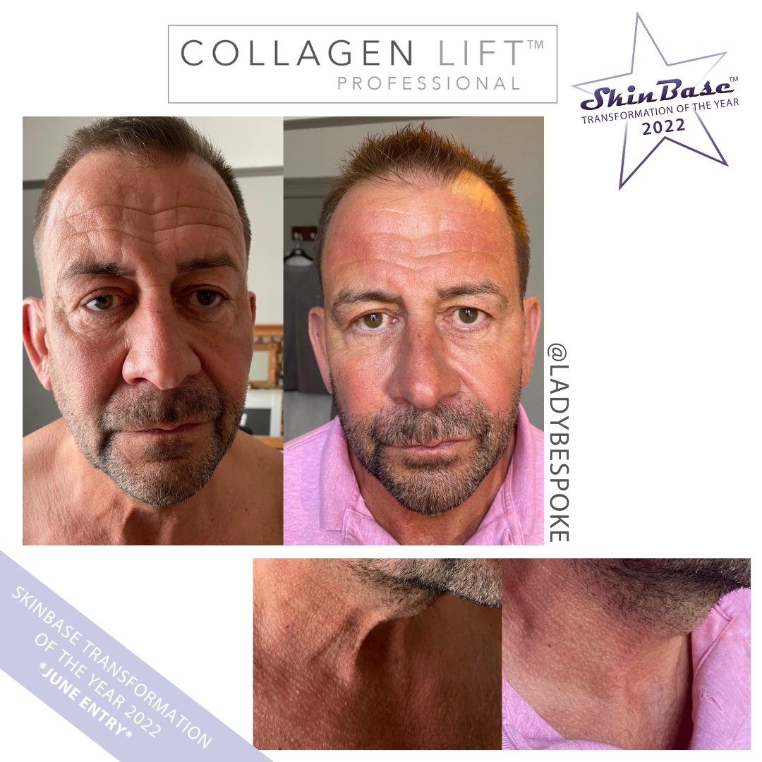 SkinBase_facial's tweet image. ⭐️ June transformation with this fabulous entry from Bespoke Male Grooming

These fantastic results were achieved through a 6 treatment course of Collagen Lift.

Click the link in our bio for your chance to Win a Holiday! #skinbase #collagenlift #transformation22