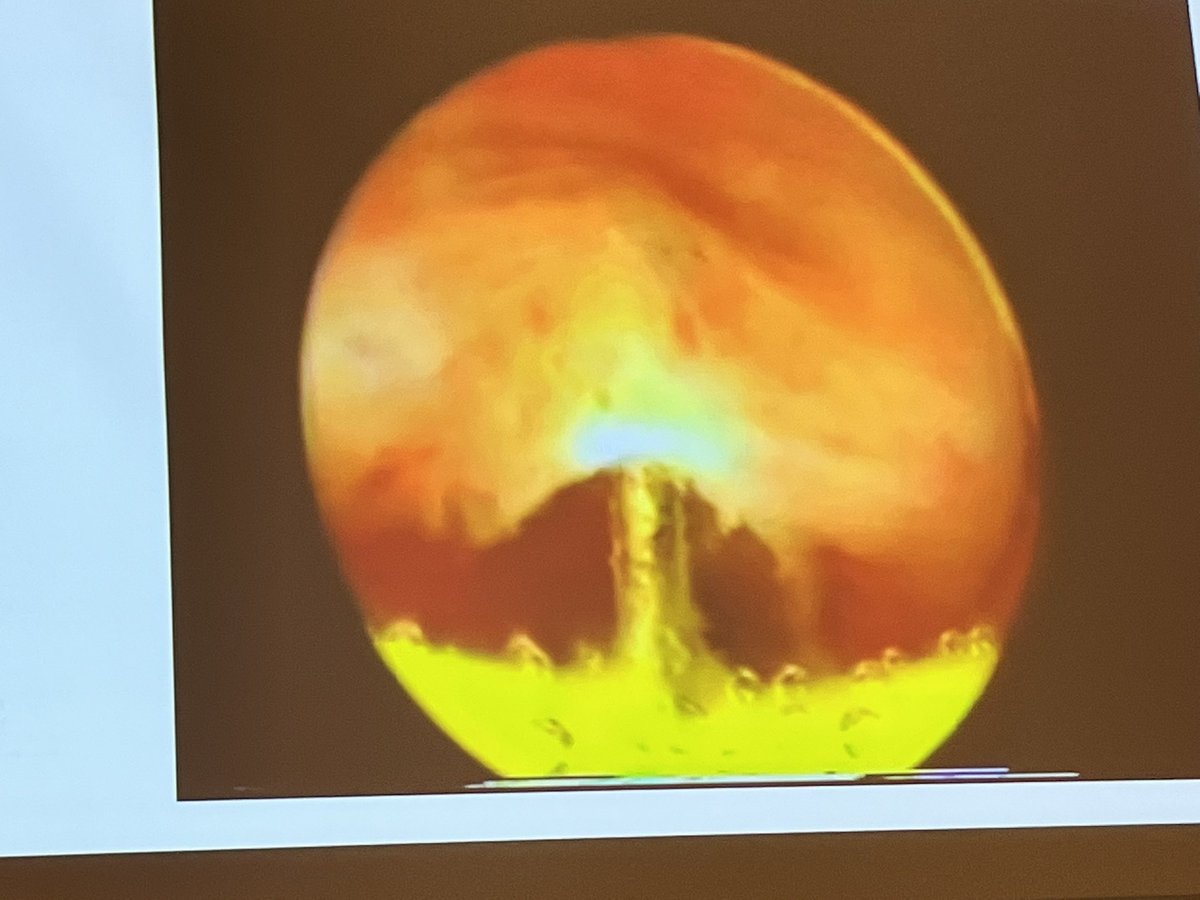 Very challenging cases #inus22 @Neuro_Urology - how to manage #spinalcordinjuries in patients who live 3,000km from specialist centres & where half the population have an income of <$500 a month.