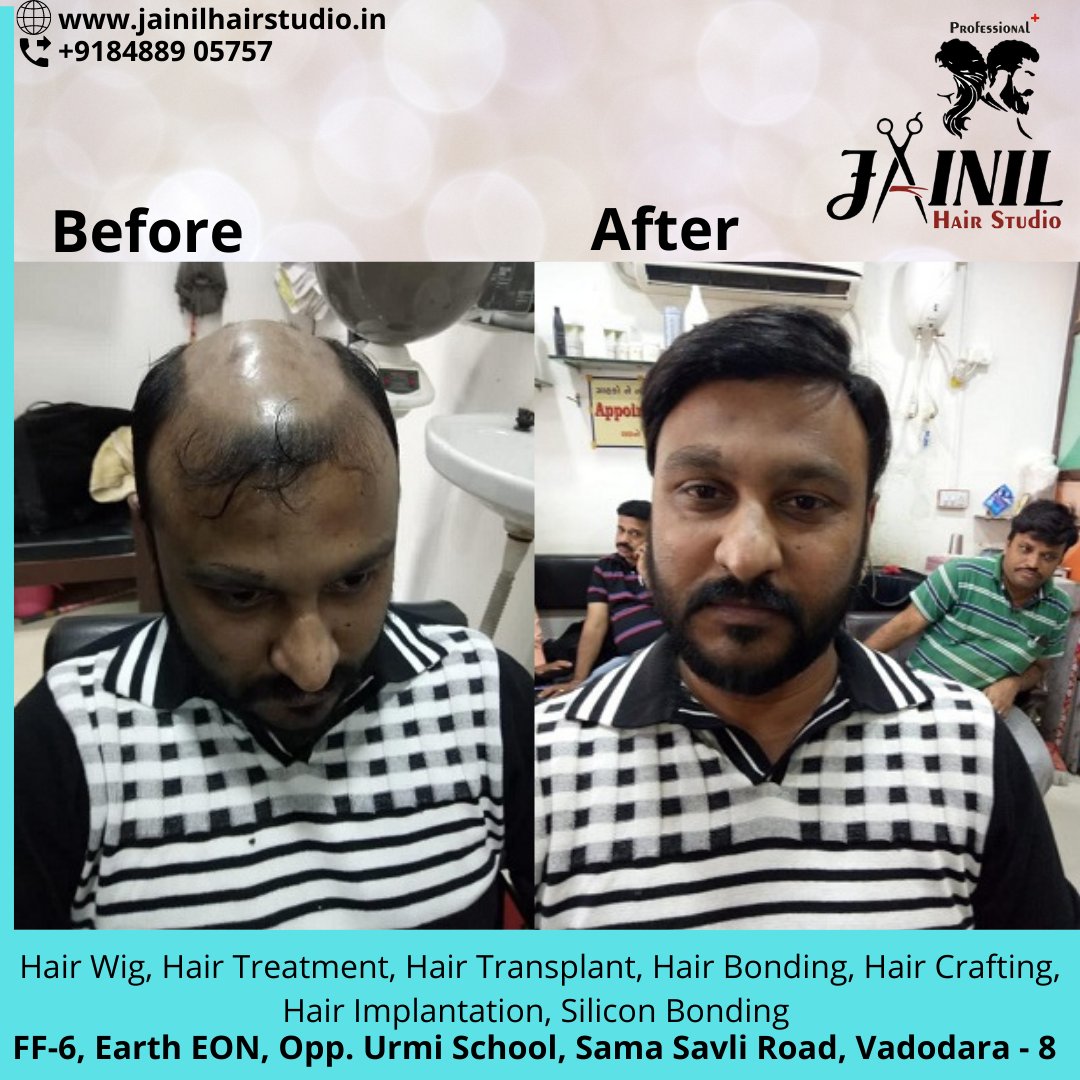 Hair Bonding in Chennai  NonSurgical Hair Replacement