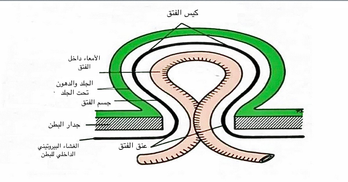 #الفتاق_وأنواعه صورة توضح أجراء الفتق البطني الخارجي