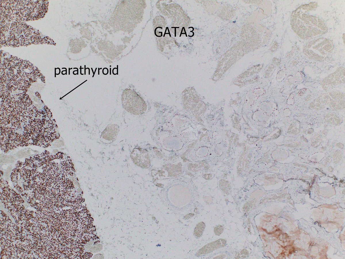aloa0's tweet photo. @BinXu16 The glandular structures are partly positive for GATA3, at weaker intensity than the adjacent parathyroid gl. Yeah..those are probably parathyroid, too. @DrJuhlin https://t.co/SbtoUcXu5L