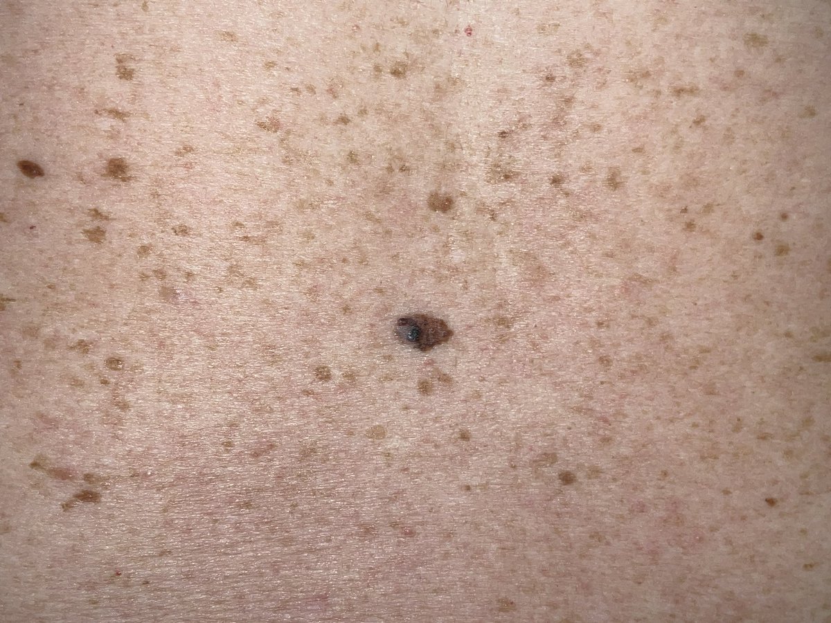 draMorenoSuarez's tweet photo. Melanoma. Antecedentes personales de quemaduras solares y utilización de cabinas de bronceado.
Dermaroscopia:
Patrón multicomponente con áreas de regresión. https://t.co/lpaxHU6gyT