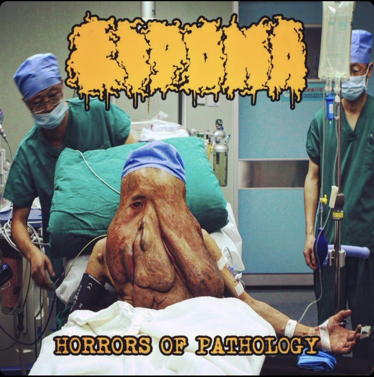 Comping soon. Lipoma: Horrors of Pathology CD on Grand Vomit Productions and Old Grindered Days Records. More info soon.