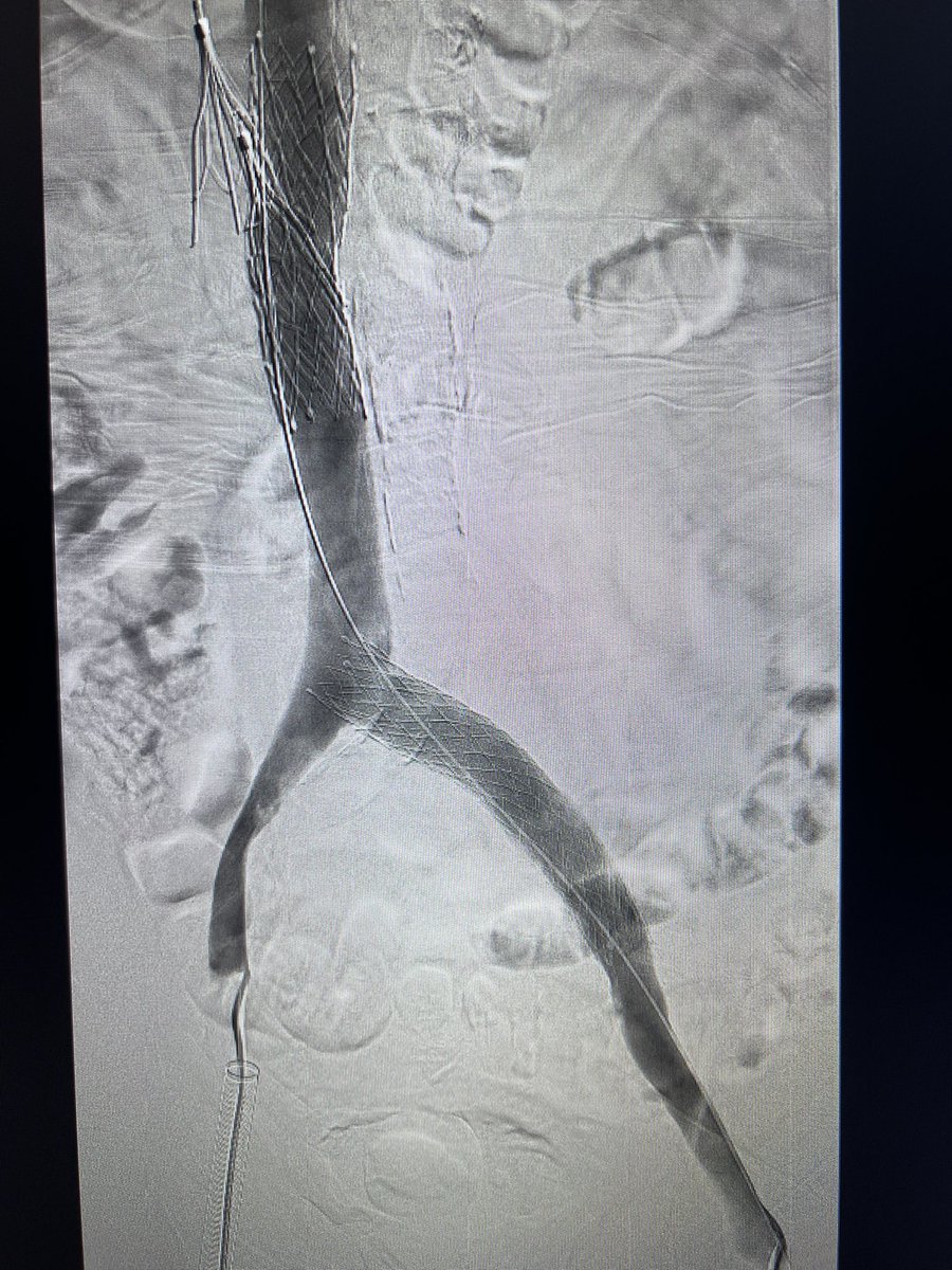 joeliechty's tweet photo. When you put 3 filters in…expect clot to follow. 75 y/o male with IVC thrombosis. #inari https://t.co/jfZ3lc64iI