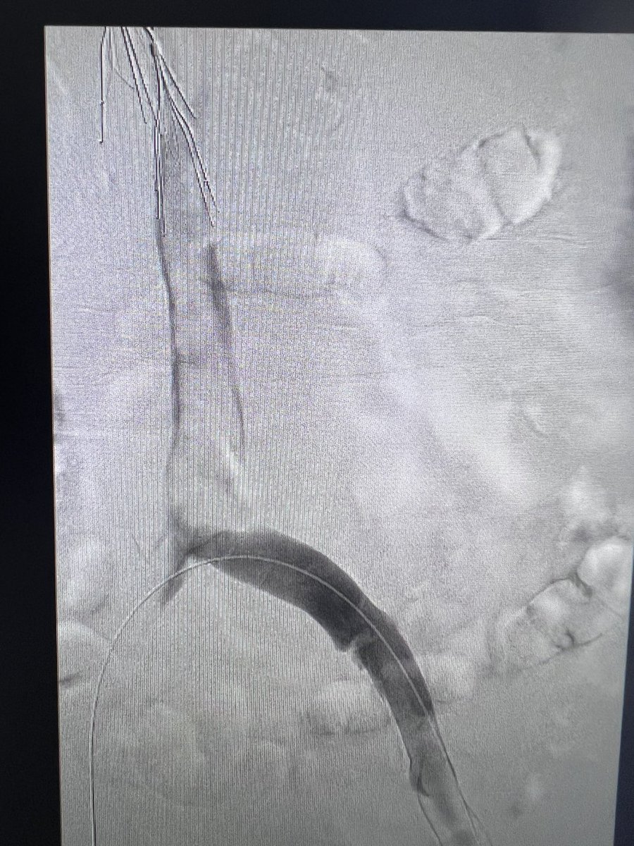 joeliechty's tweet photo. When you put 3 filters in…expect clot to follow. 75 y/o male with IVC thrombosis. #inari https://t.co/jfZ3lc64iI
