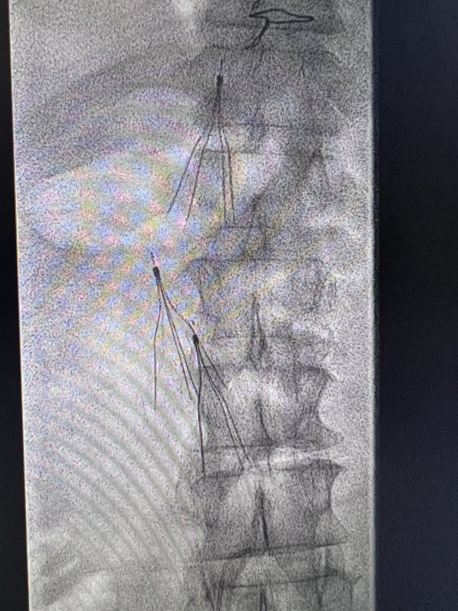 joeliechty's tweet photo. When you put 3 filters in…expect clot to follow. 75 y/o male with IVC thrombosis. #inari https://t.co/jfZ3lc64iI