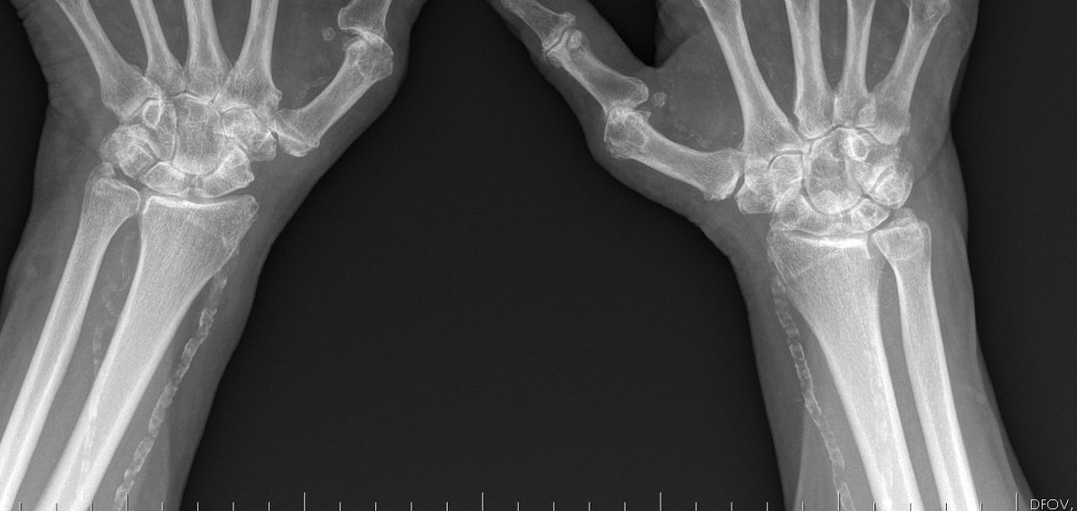 BerivanBitikMD's tweet photo. #RheumCases 74F, hyperparathyroidism (operated) and seropositive rheumatoid arthritis.  But hyperparathyroidism caused more morbidity. #rheumatology #rheumatoidarthritis https://t.co/W9ocnmc0kc