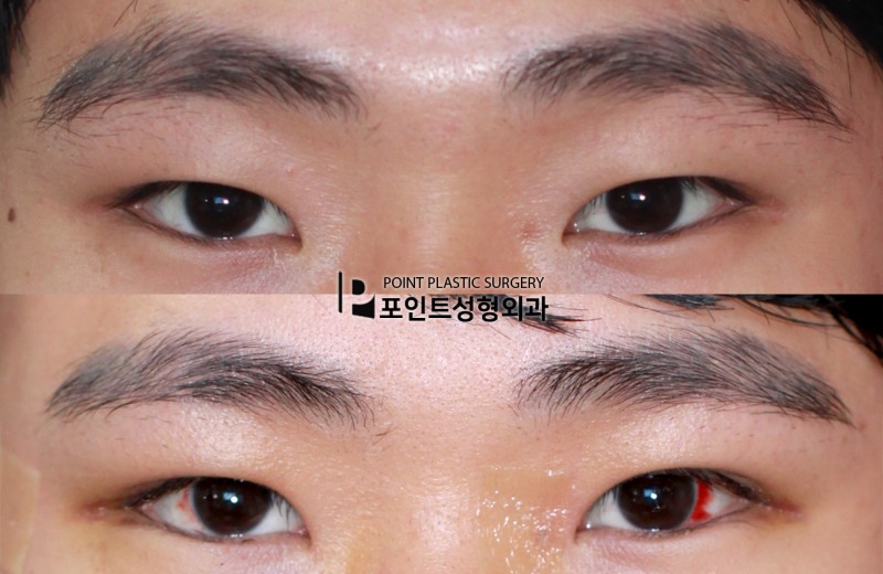 ポイント整形外科 Point整形外科 Before After 男性の一重目つき矯正 たれ目切開 目上切開で自然な仕上がりにした症例 当院のブログからより多くの目の整形症例をご紹介しております ブログ T Co Mfe2zsjxrw メンズ整形 男二