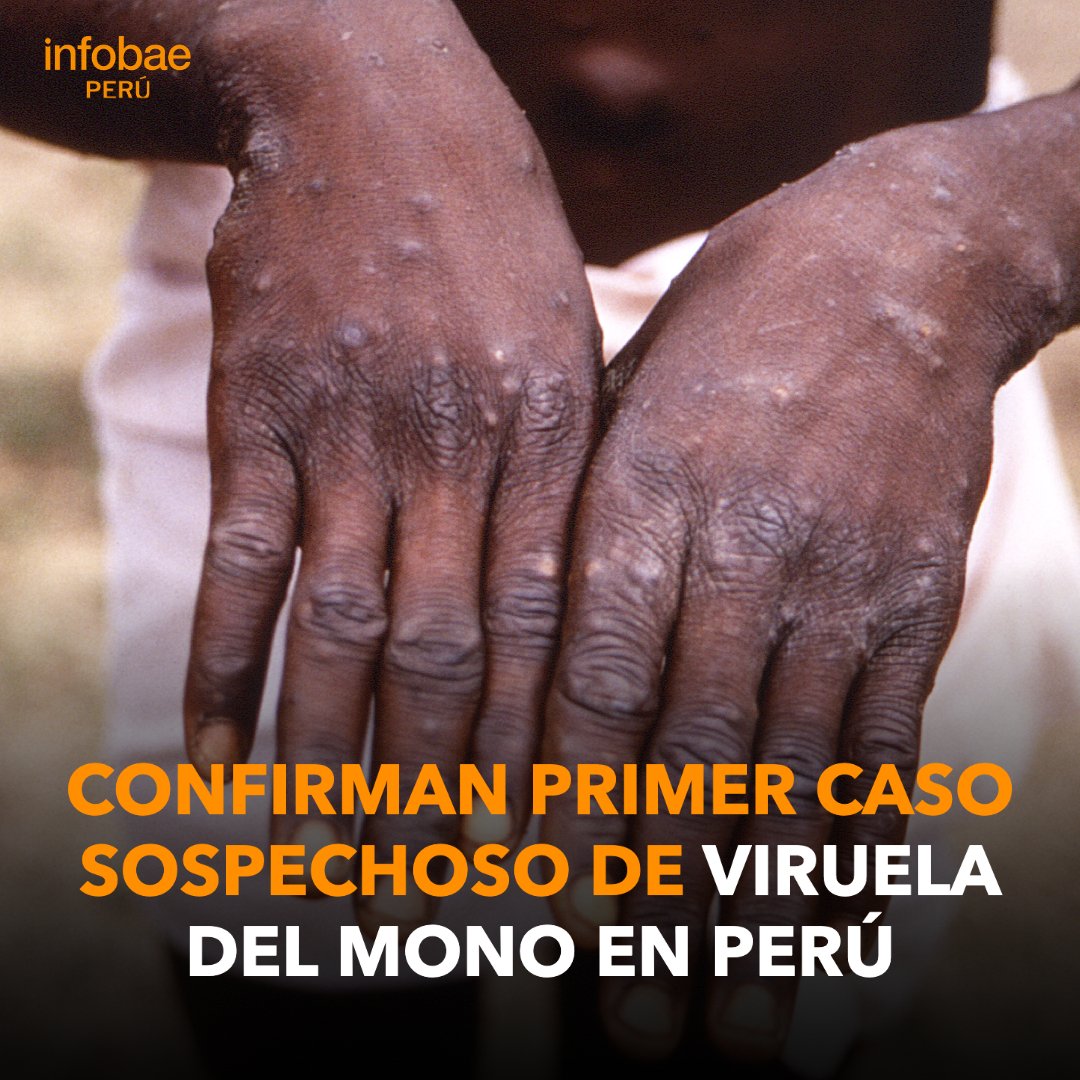 🔴 REITERAMOS | Este lunes 30 de mayo, el viceministro de Salud Percy Minaya confirmó el primer caso sospechoso de la viruela del mono en el Perú.

📌Más información ➡️ dlvr.it/SRK1hB