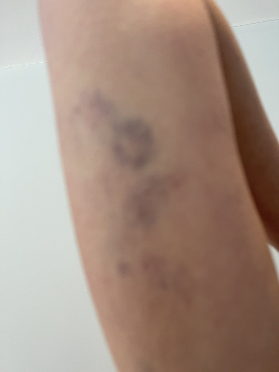 MCATEER4's tweet photo. Where were the police when my wife got mugged her watch stolen bruised and my son attack and beaten. Nowhere @GDarmanin . Pathetic excuses #UEFA #ChampionsLeagueFinal #France https://t.co/EYXLjaQ2ug