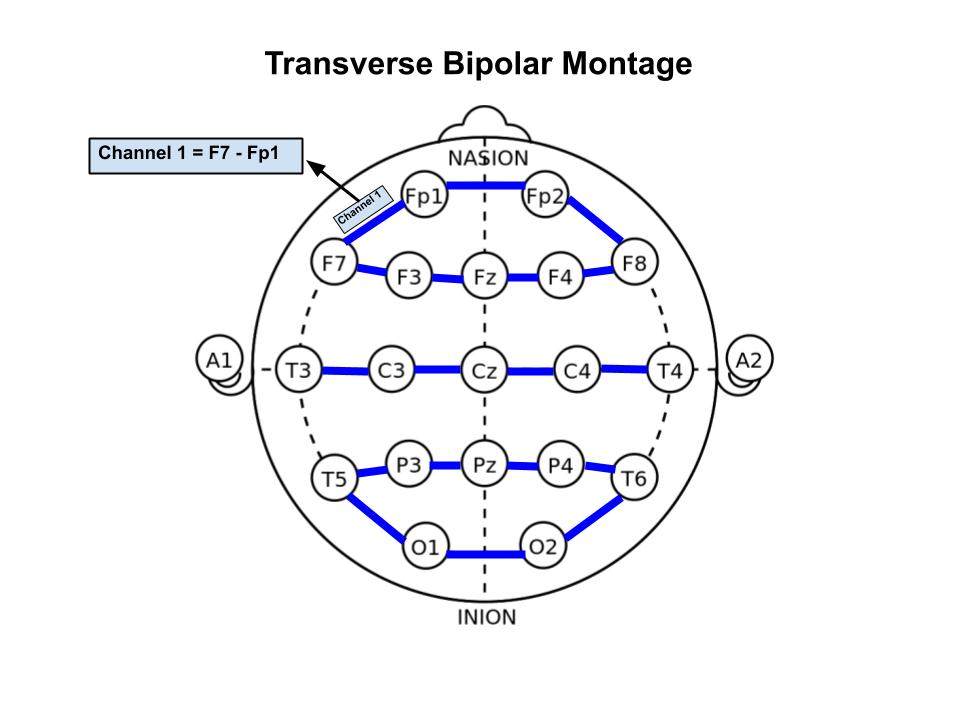 phluaria's tweet photo. FOR TOO LONG #eeg.ers have had only ONE food-based name for their display montages

BEHOLD the transverse bipolar is henceforth known as the Hamburger™ montage https://t.co/N5RN83WasF