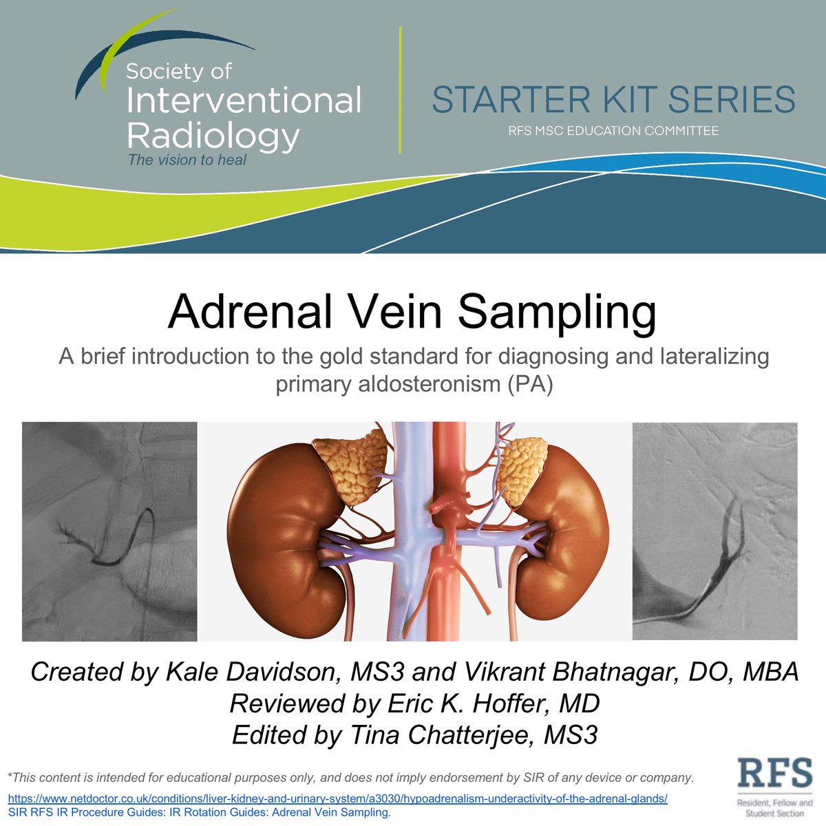 A brief introduction to Adrenal Vein Sampling, the gold standard for diagnosing & lateralizing primary aldosteronism (PA)  #irad Authors: Kale Davidson ( @Kale_Davidson_) & Vikrant Bhatnagar, DO ( @IRVikBhatnagar)Reviewer: Eric K. Hoffer, MDEducation Liaison:  @tinachatterje3