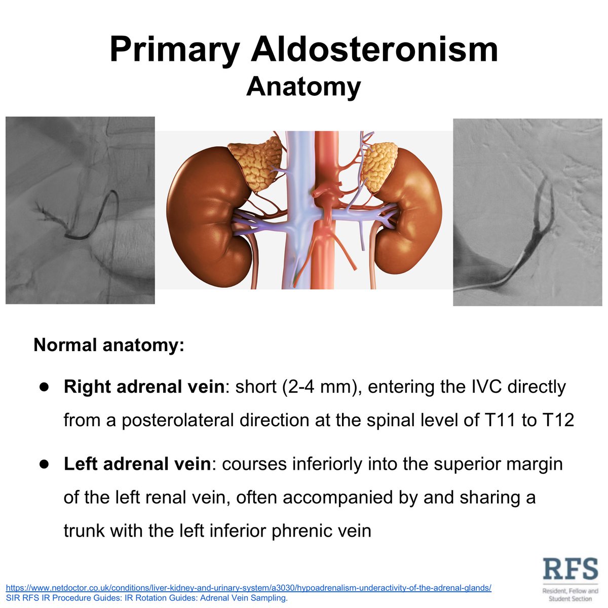 The right adrenal vein enters the IVC directly at the level of T11-T12. Meanwhile, the left adrenal vein shares a trunk with the left inferior phrenic vein branching off of the left renal vein.