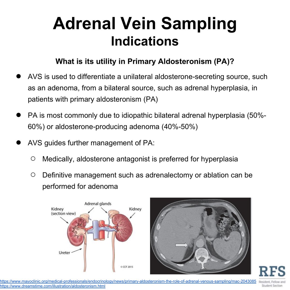 PA is most commonly due to idiopathic bilateral adrenal hyperplasia (50%-60%) or aldosterone-producing adenoma (40%-50%). AVS is is used to differentiate a bilateral source (idiopathic hyperplasia) from a unilateral source (adenoma).