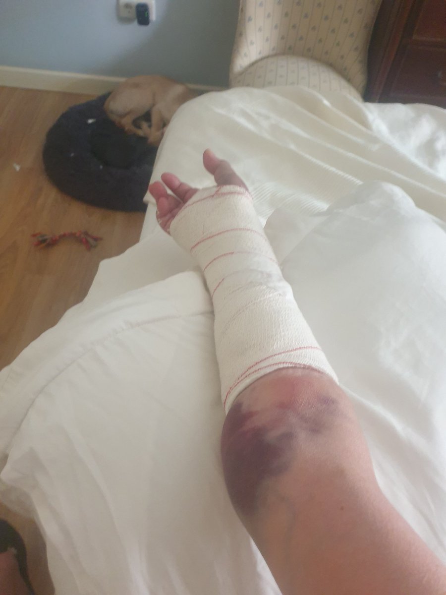 Me ha tirado un #pitbull en el parque tras morder a otro perro
Sin bozal, sin seguro.
Tengo una fractura de muñeca malísima.
O se cura u operación.
Movilidad 0. No entiendo esto! <a href="/jlopezcol/">Jesús López Colmenarejo</a> @RUrrialde_PhD