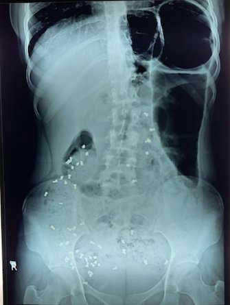 drakashmathur's tweet photo. #tweetorial #PGTeaching 
💥Colonic transit time study using radio-opaque markers
#Ghoshal's protocol 🌟
🗣️ Give 20markers each at 0,12 and 24 hrs

⚡ X-rays to be done at 36 and 60hrs https://t.co/XkRbT9OYnF