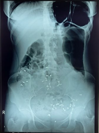 drakashmathur's tweet photo. #tweetorial #PGTeaching 
💥Colonic transit time study using radio-opaque markers
#Ghoshal's protocol 🌟
🗣️ Give 20markers each at 0,12 and 24 hrs

⚡ X-rays to be done at 36 and 60hrs https://t.co/XkRbT9OYnF