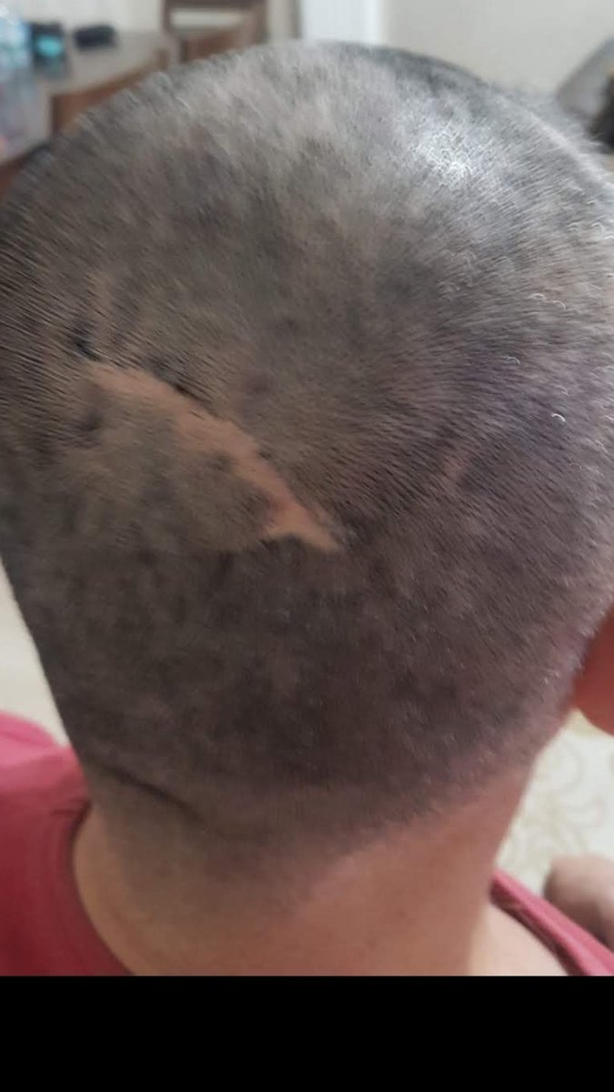 Terörle mucadelede yaralanan 20 bin arkadaşlarimdan biriyim verilen sözlerin yapilmasini verilen kanun tekliflerinin meslisden cikmasini istiyoruz 10 milyon mülteciye sahip cikan devletimiz 20 bin vatan icin toprak için pkk ile catişmada yaralanmiş 20 bin arka