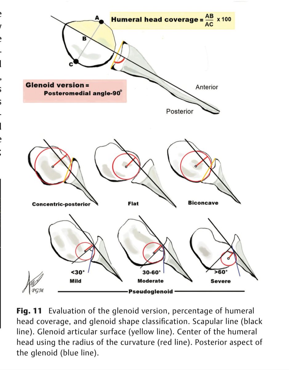 Pedro José González MD (@pedro_g_md) on Twitter photo Happy to share our article "Brachial Plexus Birth Palsy: Practical Concepts for Radiologists", published in <a href="/SMR_SeminarsMSK/">Seminars in Musculoskeletal Radiology</a>, where I also had the opportunity to show my artwork. Thank you <a href="/bedoya3aleja/">Alejandra Bedoya, MD</a> for your valuable guidance in making this possible!
thieme-connect.com/products/ejour… Happy to share our article "Brachial Plexus Birth Palsy: Practical Concepts for Radiologists", published in <a href="/SMR_SeminarsMSK/">Seminars in Musculoskeletal Radiology</a>, where I also had the opportunity to show my artwork. Thank you <a href="/bedoya3aleja/">Alejandra Bedoya, MD</a> for your valuable guidance in making this possible!
thieme-connect.com/products/ejour…