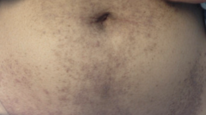 #idboardreview 25 F pet store worker w/ pharyngitis, diffuse arthralgia, synovitis &amp; daily fever x1mo. Axillary adenopathy, macular rash shown, BC/throat cultures neg. Takes no meds. Hb10, Plt 500k, ESR80, Ferritin 2k, Rf/ANA neg, AST130, ALT140, Ct mild splenomegaly #idtwitter