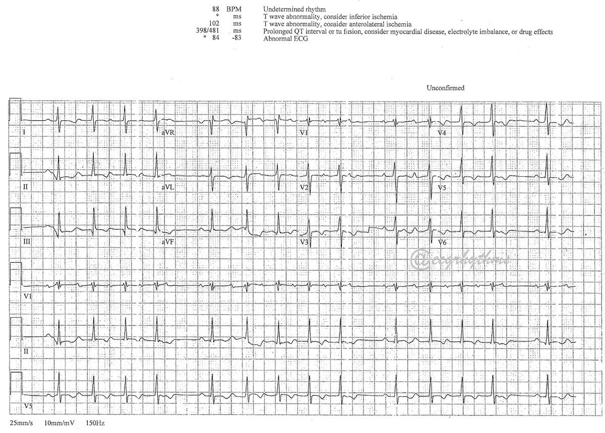 ecgrhythms's tweet photo. 1-From the archives 📦
Can you determine this 👇"undetermined" rhythm? Poll next 🐦
#FOAMed
#Meded
#Cardiotwitter
#Epepps https://t.co/mmLQsI4JeQ