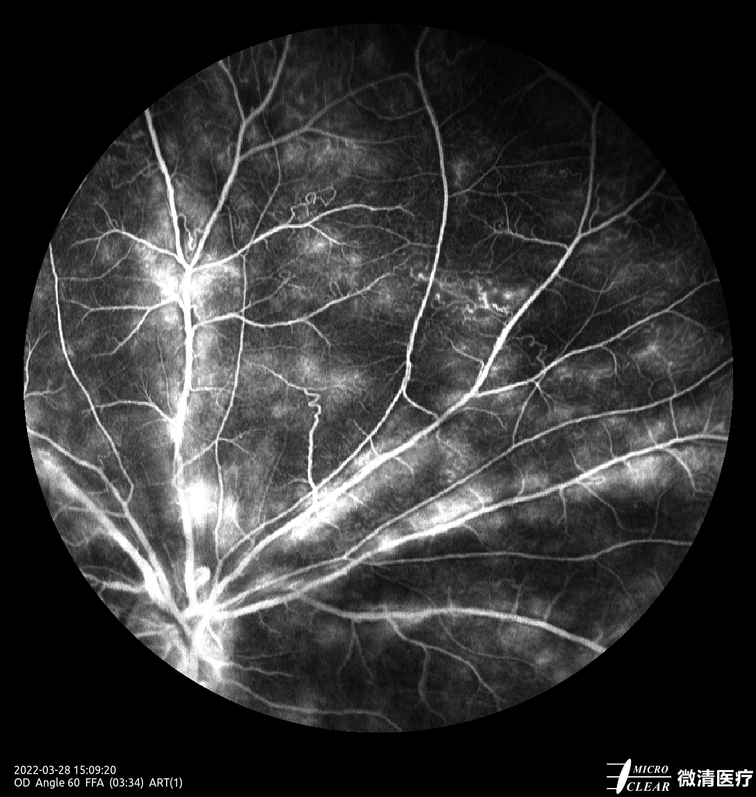 Microcleartec's tweet photo. #DR &amp; #Macularhole
Picured by Apollo, the #ConfocalRetinalOphthalmoscope
#retinopathy #funduscamera #diabeticretinopathy https://t.co/x7HvH7kE8I