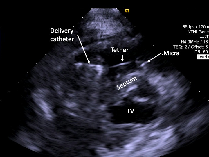 How to implant a Micra during a national contrast shortage, or in a patient with a severe contrast allergy? ICE has been described, but TTE is cheap, non-invasive and helpful to confirm septal position. @whperucki #EPeeps