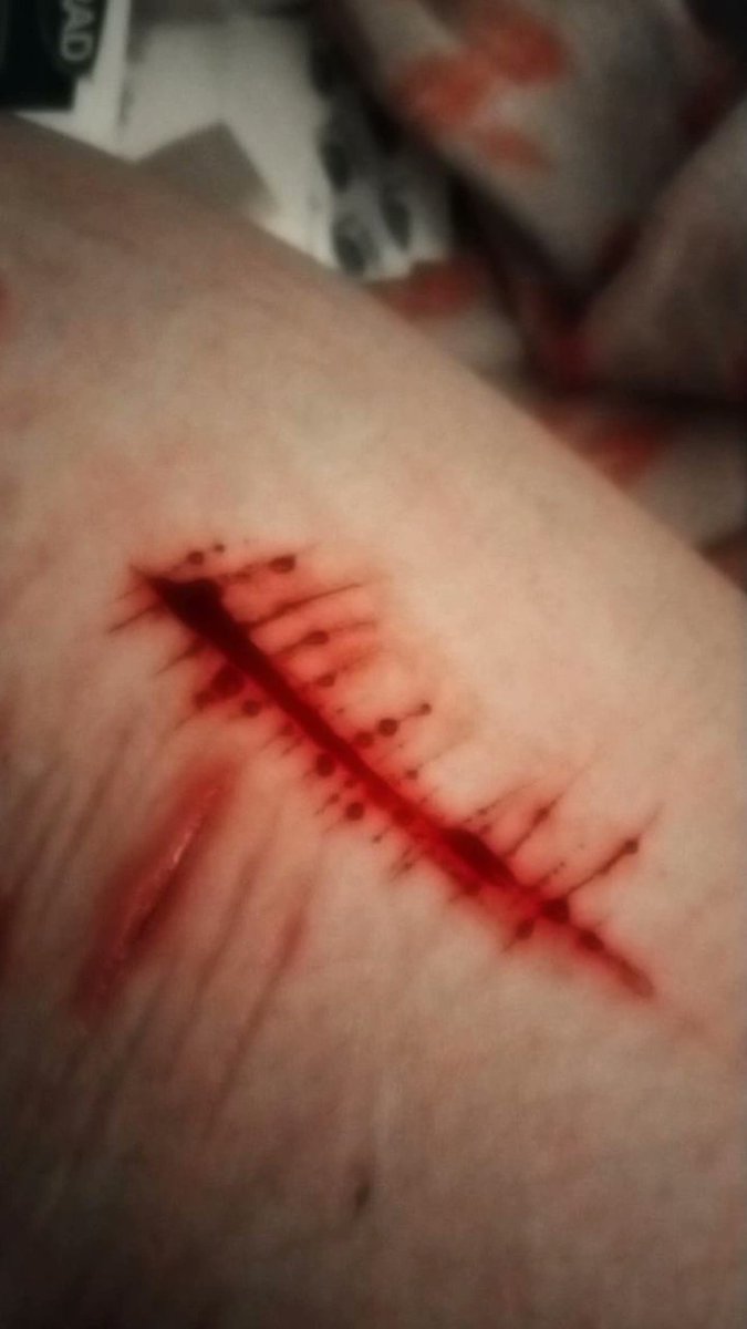 idk_how2cope's tweet photo. TW s3lfh4rm || How my leg looks rn and some styros 
.
.
.
.
.
shtwt armgillstwt styrotwt catscratchtwt babybeanstwt https://t.co/j5acE1tH1d