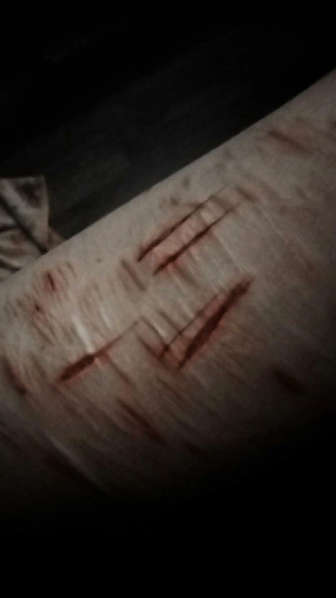 idk_how2cope's tweet photo. TW s3lfh4rm || How my leg looks rn and some styros 
.
.
.
.
.
shtwt armgillstwt styrotwt catscratchtwt babybeanstwt https://t.co/j5acE1tH1d