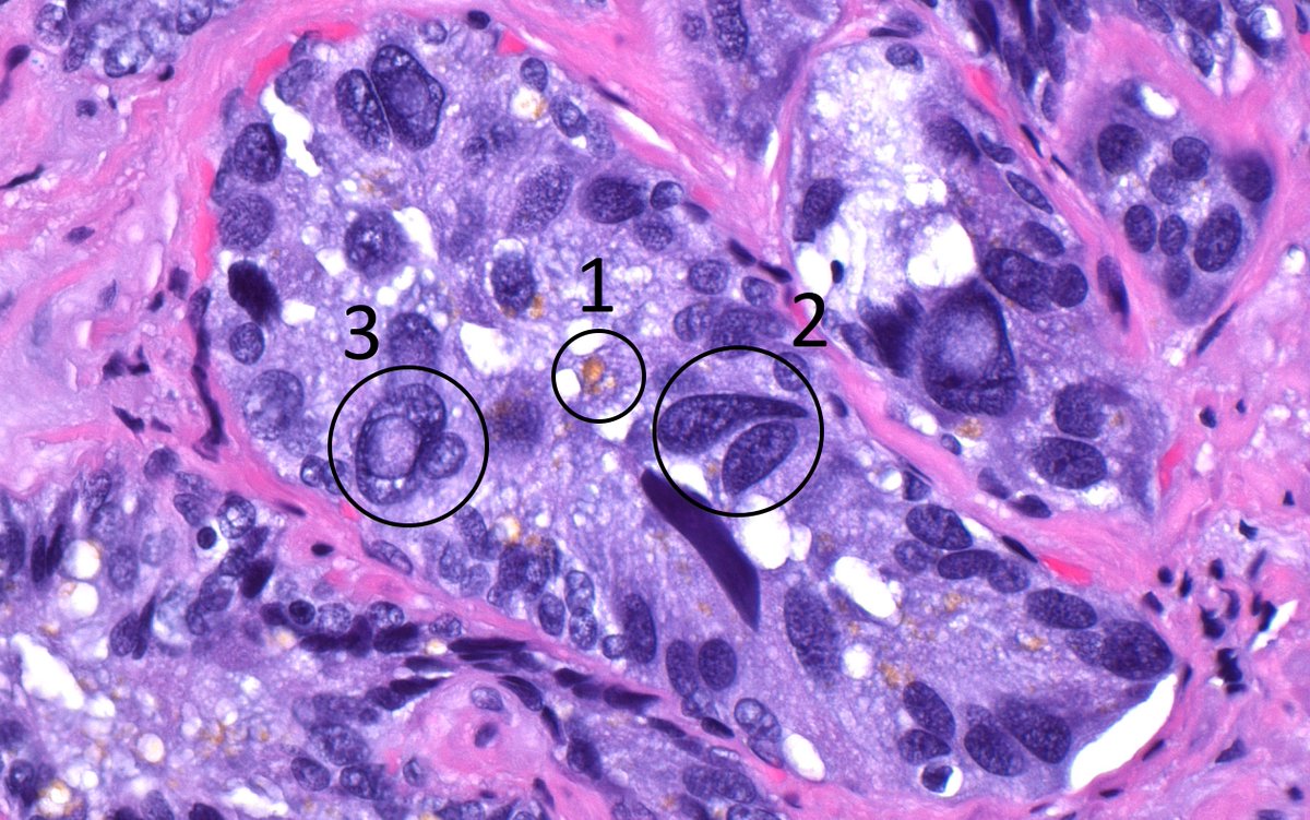ziad_zaatari's tweet photo. This Seminal Vesicle gland caught my eye with a nice demonstration of a @RoTriad: 
     1. Yellow pigment 
     2. "Monster" cells (BIG and a bit scary)
     3. Intra nuclear pseudo inclusion 

Knowing basic #histology is useful to distinguish from prostate cancer #GUpath https://t.co/b4kZPlro9L