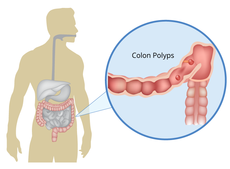 endocrinol1's tweet image. Colon polyps are clumps of cells that form on the lining of the colon.
Submissions are open for the upcoming issue.
Submit to: editor.endocrinology@maplejournal.com
Visit us: maplespub.com/journal/journa…
#fierypolyps #colonpolyps #colon #abnormalcellgrowth