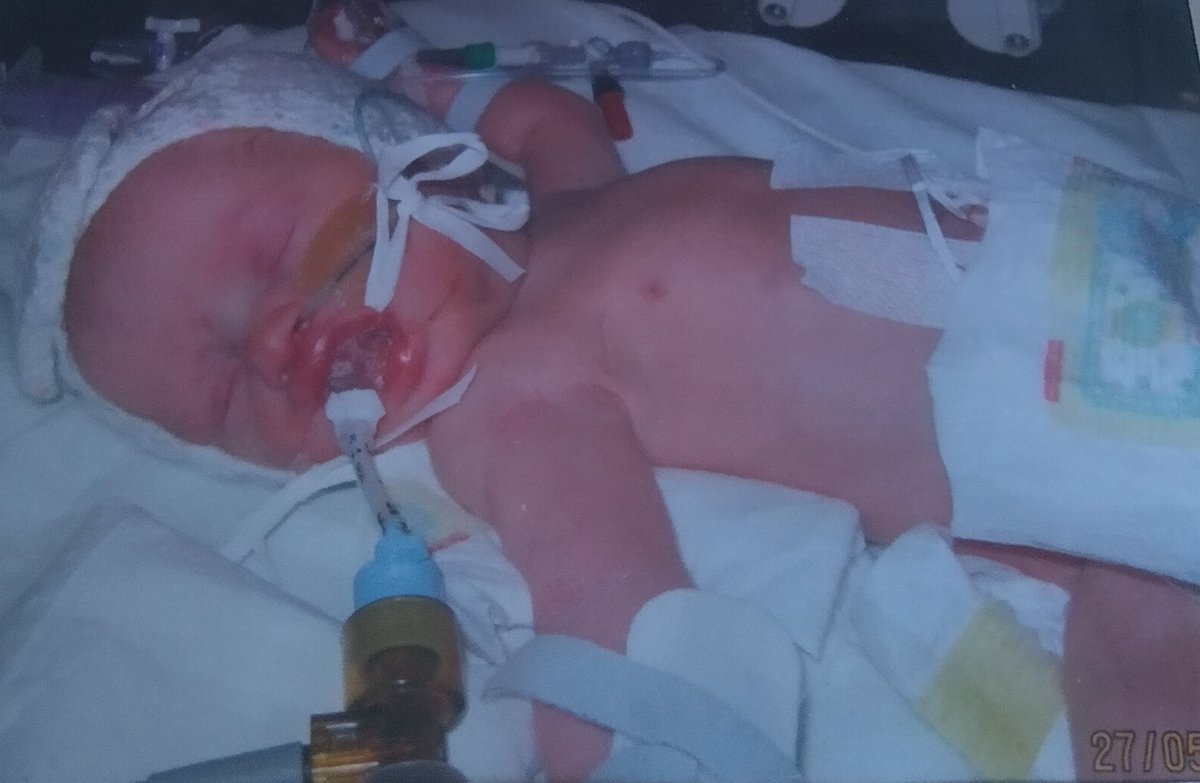emmaweaver's tweet photo. 8 years gorgeous girl. Love you so much and miss you beyond words ❤️ #ThePowerOfGeorgie #babyloss #1in4 #8years #doesntgeteasier #grief #love #trachealagenesis https://t.co/m7BK4vF0t4