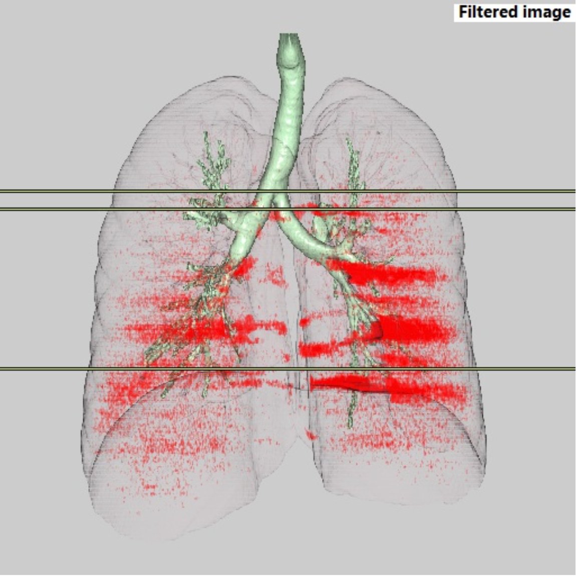 viks_rum's tweet photo. I took a preventive lung scan and this is what 4 years of Gurgaon air does to you. Glad to have moved to Bangalore. 

The red spots indicate mucosa in my inner lungs to combat the effects of pollution. I don't even smoke! https://t.co/RGwowyIXmW
