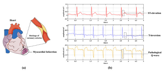 Biosensors_MDPI's tweet photo. #Article
π’ EvoMBN: Evolving Multi-Branch Networks on Myocardial Infarction Diagnosis Using 12-Lead #Electrocardiograms
Read more: https://t.co/xtS9lLPjr5
#myocardialinfarction
#convolutionalneuralnetworks
#architectureoptimization https://t.co/eqgdV9iSPC