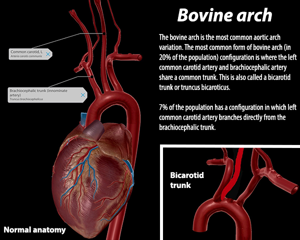 VisibleBody's tweet photo. The term anatomical variant refers to deviations from the norm that don’t impair functions. Want to learn more about anatomical variations of the circulatory system? https://t.co/2DdtlYnjlr
#anatomicalvariations #circulatorysystem #anatomy #learningresources https://t.co/MdiGoozTVY