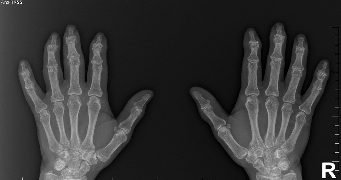 BerivanBitikMD's tweet photo. #RheumCases 53F, psoriatic arthritis with peripheral and axial involvement, I can only give infliximab, she cannot tolerate leflunomide, and MTX. She is being followed by psychiatry for panic attacks. #rheumatology #RheumTwitter https://t.co/qYrl4adJH3