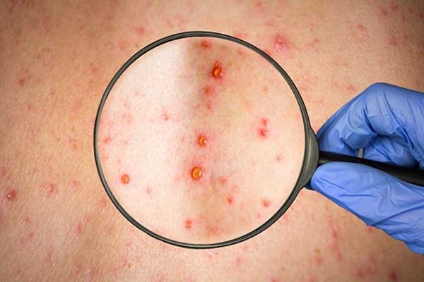 2 more cases of monkeypox in London: UK health agency

#thedoctorsmail  #thedoctors  #doctors  #doctor  #doctorsmail  #medicalnews #GlobalNews  #MedicalEdge #monkeypox #viralinfection #UKHSA #StMarysHospital #ImperialCollegeHealthcareNHSTrust #smallpox #DRC