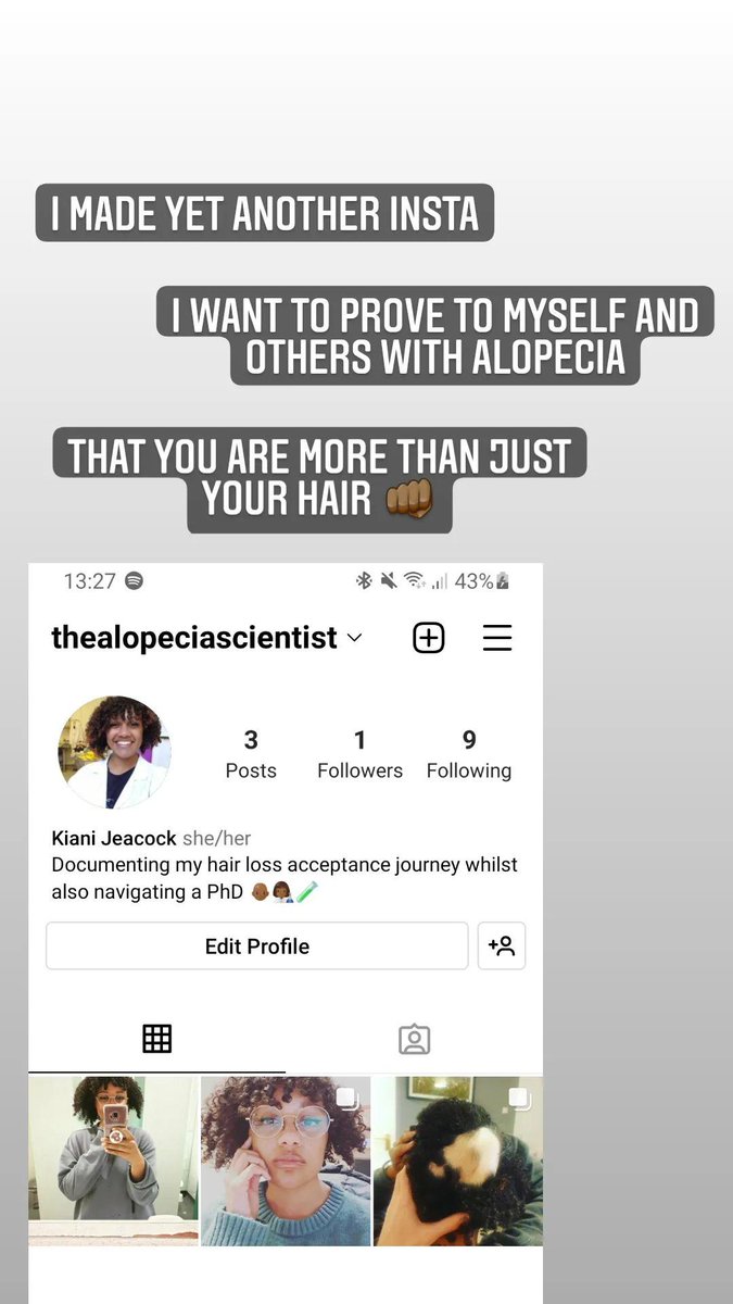 Kiani Jeacock (@kianijeacock) on Twitter photo I've had alopecia areata for 3 years now & I definitely haven't reached a place of self acceptance yet. But I'm documenting my hair loss journey to spread positivity, raise awareness and reduce #alopecia stigma π©πΎβ𦲠<a href="/AlopeciaUK/">Alopecia UK</a> <a href="/alopeciaworld/">Alopecia World</a> <a href="/AlopeciaSupport/">Alopecians United</a> #alopeciaawareness I've had alopecia areata for 3 years now & I definitely haven't reached a place of self acceptance yet. But I'm documenting my hair loss journey to spread positivity, raise awareness and reduce #alopecia stigma π©πΎβ𦲠<a href="/AlopeciaUK/">Alopecia UK</a> <a href="/alopeciaworld/">Alopecia World</a> <a href="/AlopeciaSupport/">Alopecians United</a> #alopeciaawareness