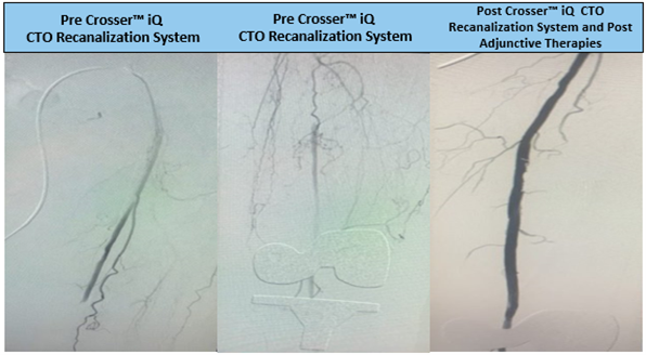 Todd_BDPI's tweet photo. Mid & distal SFA diseased lesion. Case by @ehrin_armstrong - crossed a 15cm CTO using #CrosseriQ catheter & observed a 45 sec activation time. Great results! #CrossThisFast
For use in peripheral artery CTOs; Not for use in carotid arteries. Safety info: https://t.co/vTk9tdbQOq https://t.co/yXOZ1IP99S