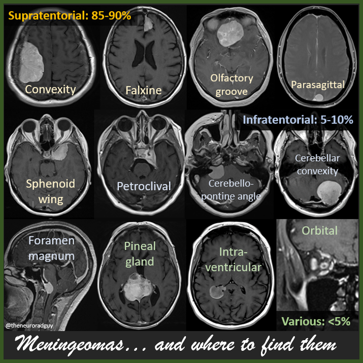 The Neuroradiologist on Twitter "Meningeomas, and where to find them (not exhaustive list, but