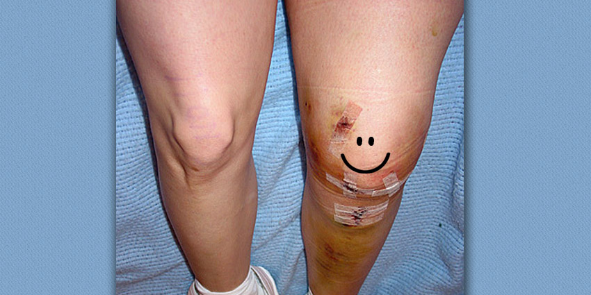 Ryortho1's tweet image. What’s the psychology of NOT using the patient’s own tissues (autograft) to repair? This study has interesting answers. ryortho.com/breaking/whats… 
#ACL #BostonChildrensHospital #UniversityofVermont # BrownUniversity #RhodeIslandHospital #otw #orthopedicsthisweek #orthopedics