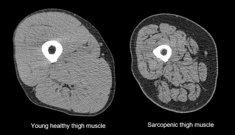 Older adults lose muscle mass with aging, which is termed sarcopenia. One of the underlying mechanisms is that they are less responsive to anabolic (muscle building) stimuli such as protein ingestion. To compensate, older adults need to eat more protein than younger adults. 

2/
