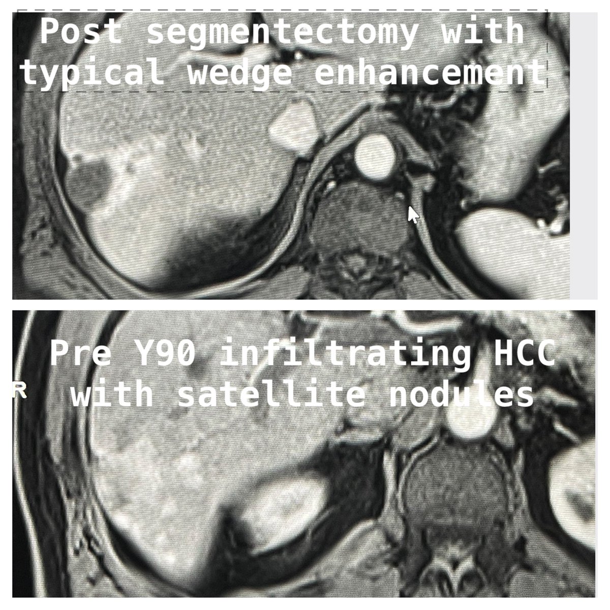 bhat_ambarish's tweet photo. #Radseg great application for HCC. Tumor free- status post 2 years after rad seg -calculated absorbed dose to tumor >250 Gy. @SirtexMedical @SIRRFS @SIR_ECS @SIRspecialists @ISVIRIndia @CAIRweb @ajgunnmd @danbrownIO https://t.co/nkRfgfOauY