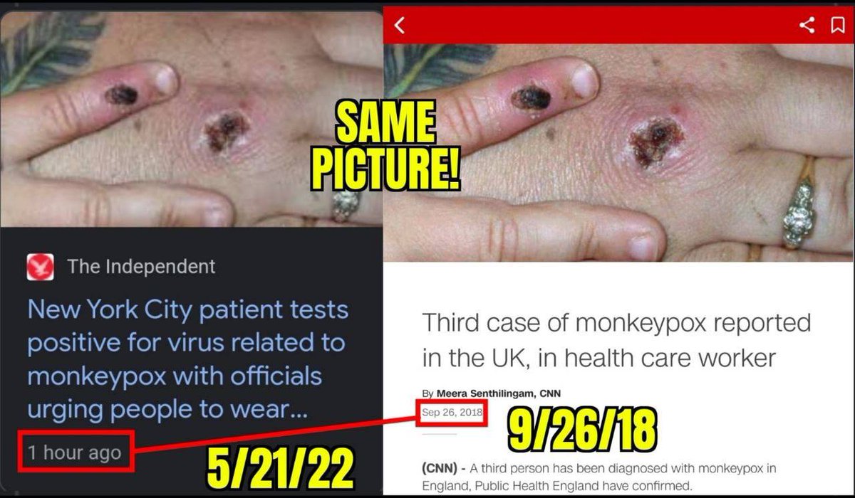 Oala, media barat yg kampanyekan Hoax Cacar Monyet ternyata pakai Kasus dengan Foto2 yang sudah lama terjadi, khususnya di Afrika. Pantas saja negara2 Afrika Menolak Keras Serangan Palsu Cacar Monyet.