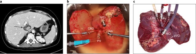 Transplantation of a human liver following 3 days of ex situ normothermic preservation go.nature.com/3axJW6F