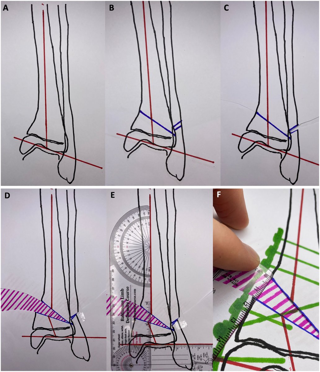 AOFAS_Journals's tweet image. This tip provides a surgical option to correct a distal tibial varus deformity resulting from medial tibial physeal arrest. Using an oblique opening wedge distal tibia osteotomy, surgeons can correct coronal plane deformity in the pediatric population. doi.org/10.1177/107110…