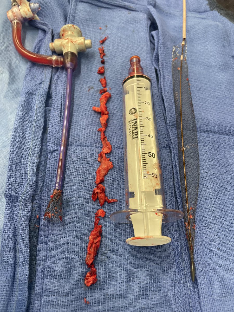 DrJayMohan's tweet photo. Holy chronic! 50 year old (😢) with adenoCA of the colon with Mets to liver. One pass. Sending to path. Let’s see what we find! #Clot #VTE #DVT #thrombectomy #Nolytics #PTS https://t.co/Mqu00k9SmY