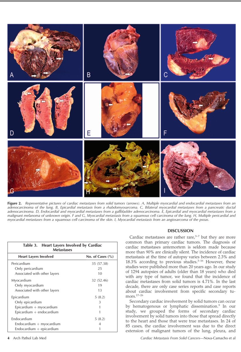 angelpanizo1's tweet image. Our work presented as a poster at  #USCAP2020 109th Annual Meeting is just published at @ArchivesPath Congratulations @LuizMiguelN !!!
"Cardiac Metastasis From Solid Cancers: A 35-Year Single-Center Autopsy Study"
meridian.allenpress.com/aplm/article/d…
#pathology #autopsy #CVpath