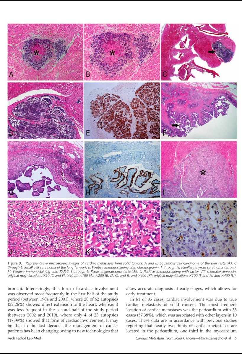 angelpanizo1's tweet image. Our work presented as a poster at  #USCAP2020 109th Annual Meeting is just published at @ArchivesPath Congratulations @LuizMiguelN !!!
"Cardiac Metastasis From Solid Cancers: A 35-Year Single-Center Autopsy Study"
meridian.allenpress.com/aplm/article/d…
#pathology #autopsy #CVpath